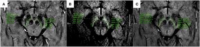 Application value of multiparametric MRI for evaluating iron deposition in the substantia nigra in Parkinson's disease